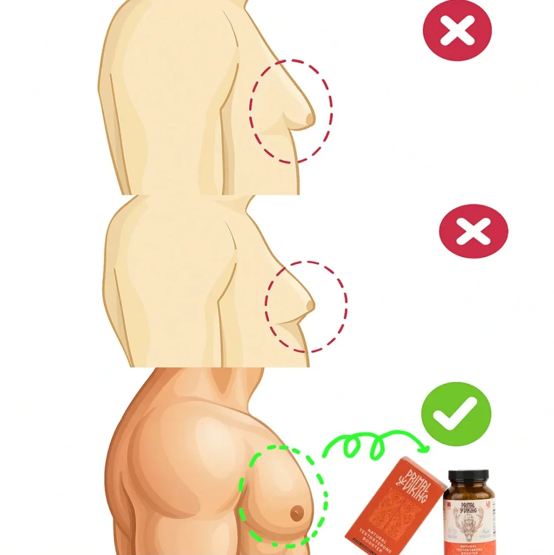 Ilustración: reducción de pecho masculino
